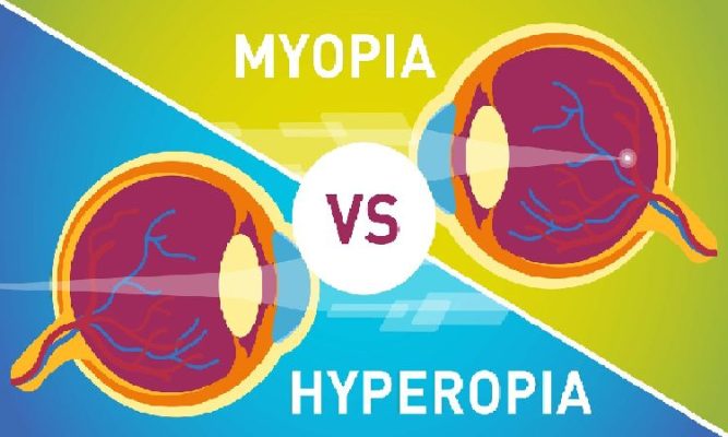 hyperopia and myopia