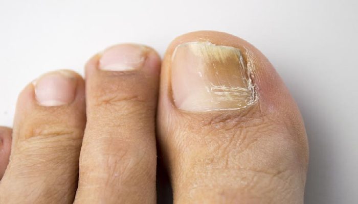 one cup of this will destroy your nail fungus